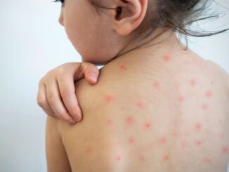 Crece el Brote de Sarampión: 39 casos confirmados en Cuauhtémoc, Namiquipa y Buenaventura