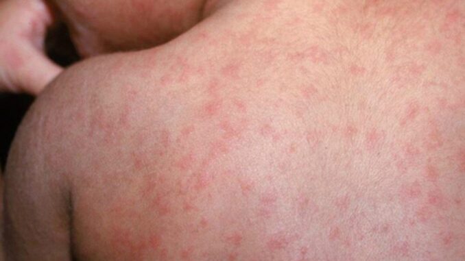 Guanajuato confirma primer caso de sarampión