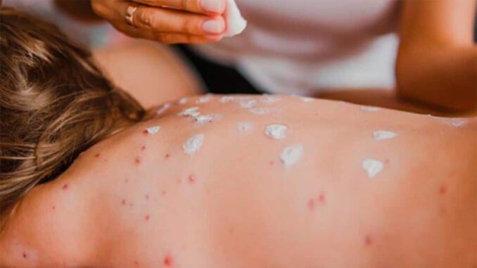 BCS identifica tres casos probables de sarampión en niños