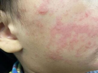 Sarampión supera los 2 mil casos en lo que va de 2026