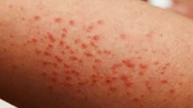 OPS alerta por repunte de sarampión en las Américas y pide reforzar vacunación