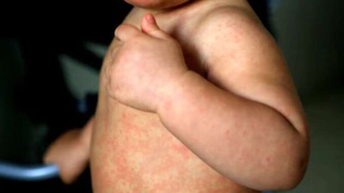 México rebasa los 10 mil casos de sarampión